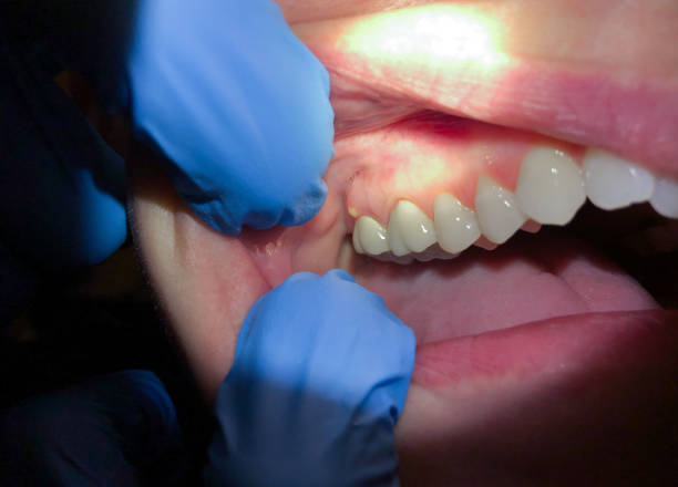 Best Emergency Treatment for Dental Infections or Abscesses in Black Hammock, FL