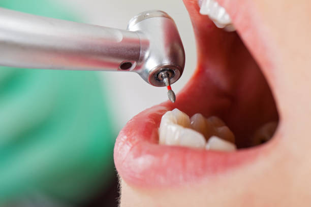 Best Emergency Treatment for Dental Infections or Abscesses in Black Hammock, FL